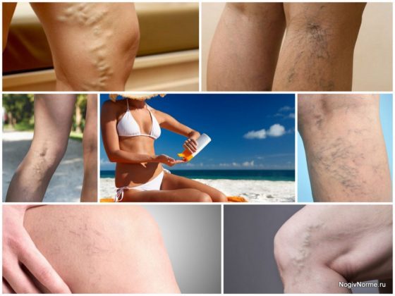 Варикоз: особенности при посещении солярия и принятия солнечных ванн и их влияние на развитие недуга