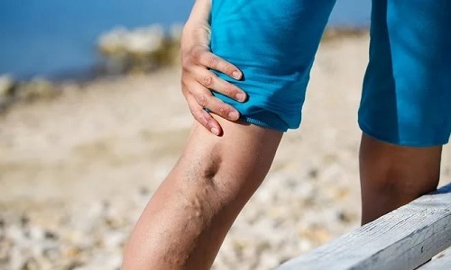 Варикоз: особенности при посещении солярия и принятия солнечных ванн и их влияние на развитие недуга