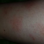 Варикоз половых губ при беременности: симптомы, причины, лечение, осложнения, профилактика, естественный роды при варикозе вен половых губ