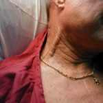 Варикоз половых губ при беременности: симптомы, причины, лечение, осложнения, профилактика, естественный роды при варикозе вен половых губ