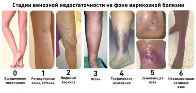 Варикоз при беременности в паху: причины, симптомы, лечение (медикаменты, гимнастика), осложнения, профилактика (компрессионное белье, диета), роды