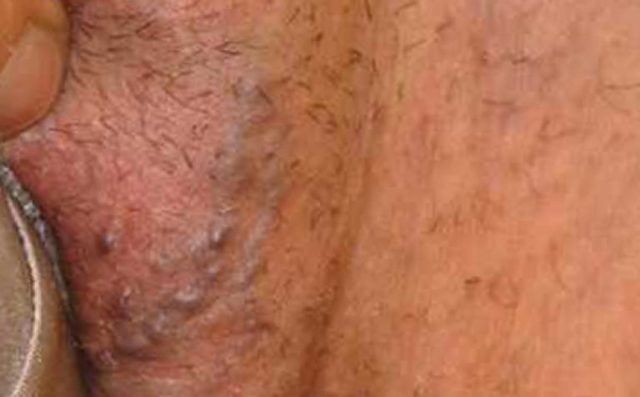 Варикоз при беременности в паху: причины, симптомы, лечение (медикаменты, гимнастика), осложнения, профилактика (компрессионное белье, диета), роды