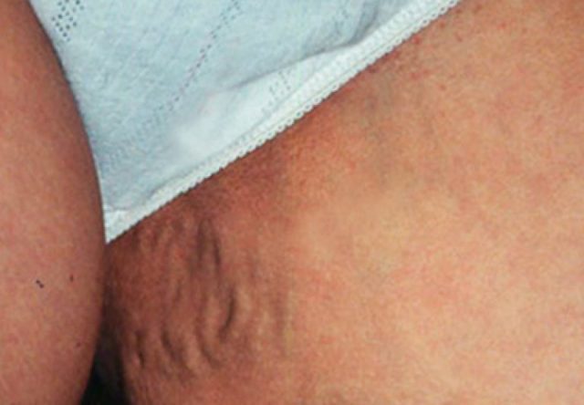 Варикоз при беременности в паху: причины, симптомы, лечение (медикаменты, гимнастика), осложнения, профилактика (компрессионное белье, диета), роды