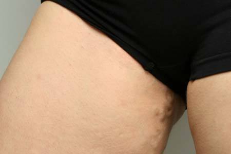 Варикоз влагалища: особенности родов при беременности, симптомы (как выглядит), как лечить