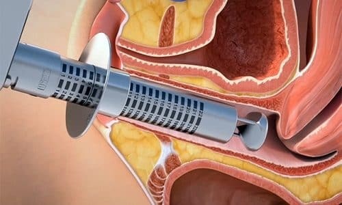 Варикоз влагалища: особенности родов при беременности, симптомы (как выглядит), как лечить
