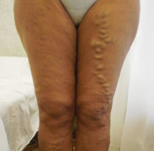 Варикоз влагалища: особенности родов при беременности, симптомы (как выглядит), как лечить