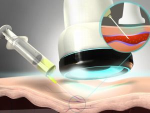 Варикоз влагалища: особенности родов при беременности, симптомы (как выглядит), как лечить