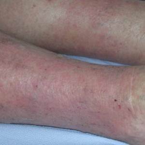 Варикозная экзема: симптомы, причины, лечение (медикаменты, народные средства, физиотерапия), профилактика (диета), последствия