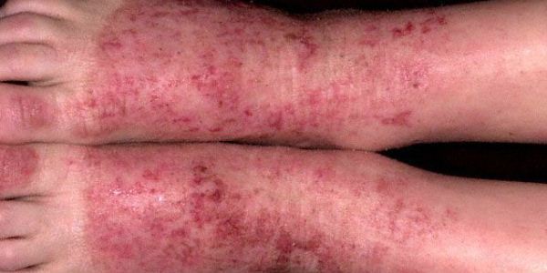 Варикозная экзема: симптомы, причины, лечение (медикаменты, народные средства, физиотерапия), профилактика (диета), последствия