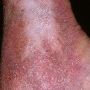 Варикозная экзема: симптомы, причины, лечение (медикаменты, народные средства, физиотерапия), профилактика (диета), последствия