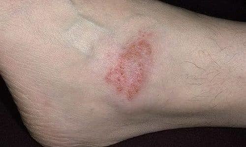 Варикозная экзема: симптомы, причины, лечение (медикаменты, народные средства, физиотерапия), профилактика (диета), последствия