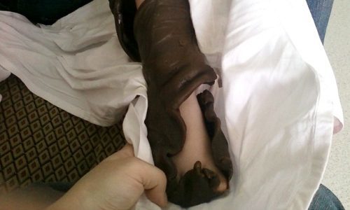 Варикозная экзема: симптомы, причины, лечение (медикаменты, народные средства, физиотерапия), профилактика (диета), последствия