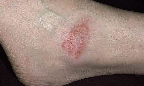 Варикозная экзема: симптомы, причины, лечение (медикаменты, народные средства, физиотерапия), профилактика (диета), последствия