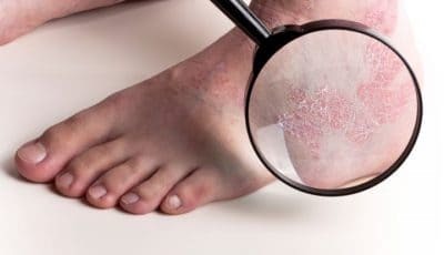 Варикозная экзема: симптомы, причины, лечение (медикаменты, народные средства, физиотерапия), профилактика (диета), последствия