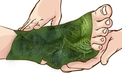 Варикозная экзема: симптомы, причины, лечение (медикаменты, народные средства, физиотерапия), профилактика (диета), последствия