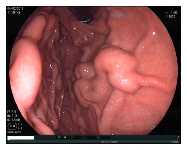Варикозное расширение вен пищевода: лечение, степени, симптомы, причины