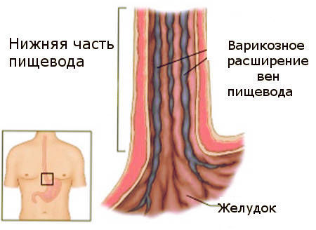 Варикозное расширение вен пищевода: лечение, степени, симптомы, причины