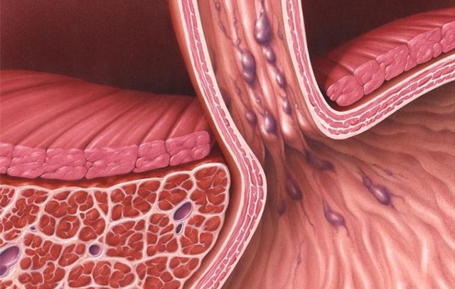 Варикозное расширение вен пищевода: лечение, степени, симптомы, причины