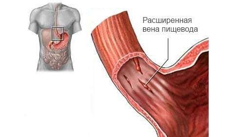 Варикозное расширение вен пищевода: лечение, степени, симптомы, причины