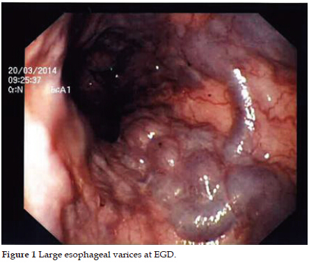 Варикозное расширение вен пищевода: лечение, степени, симптомы, причины