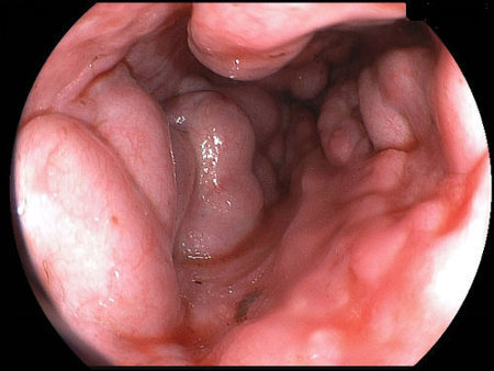Варикозное расширение вен пищевода: лечение, степени, симптомы, причины