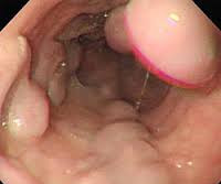 Варикозное расширение вен пищевода: лечение, степени, симптомы, причины