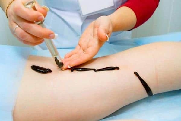 Варикозный дерматит: причины, симптомы, стадии, лечение (народное, медикаментозное, оперативное), осложнения, профилактика