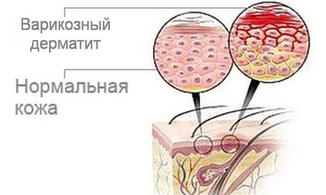 Варикозный дерматит: причины, симптомы, стадии, лечение (народное, медикаментозное, оперативное), осложнения, профилактика