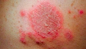 Варикозный дерматит: причины, симптомы, стадии, лечение (народное, медикаментозное, оперативное), осложнения, профилактика