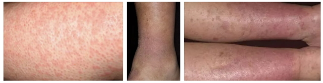 Варикозный дерматит: причины, симптомы, стадии, лечение (народное, медикаментозное, оперативное), осложнения, профилактика