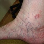 Варикозный дерматит: причины, симптомы, стадии, лечение (народное, медикаментозное, оперативное), осложнения, профилактика