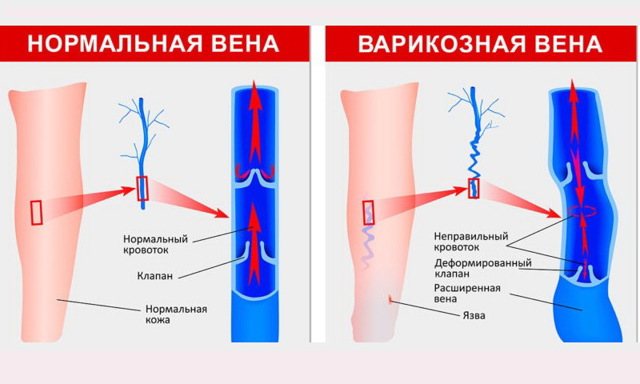 Варикозный дерматит: причины, симптомы, стадии, лечение (народное, медикаментозное, оперативное), осложнения, профилактика