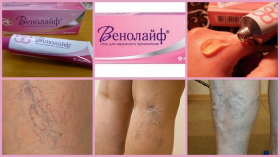 Венолайф (гель) при варикозе – инструкция по применению, отзывы, аналоги, форма выпуска, побочные действия, противопоказания, цена