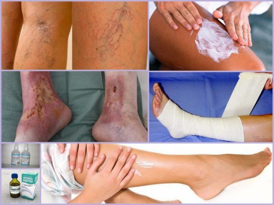 Венолайф (гель) при варикозе – инструкция по применению, отзывы, аналоги, форма выпуска, побочные действия, противопоказания, цена