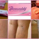 Венолайф (гель) при варикозе – инструкция по применению, отзывы, аналоги, форма выпуска, побочные действия, противопоказания, цена
