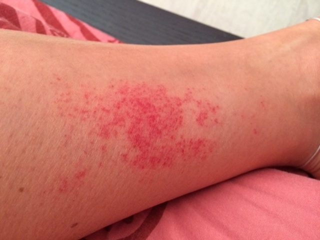 Венолайф (гель) при варикозе – инструкция по применению, отзывы, аналоги, форма выпуска, побочные действия, противопоказания, цена