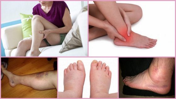 Венолайф (гель) при варикозе – инструкция по применению, отзывы, аналоги, форма выпуска, побочные действия, противопоказания, цена