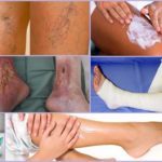 Венолайф (гель) при варикозе – инструкция по применению, отзывы, аналоги, форма выпуска, побочные действия, противопоказания, цена