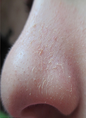 Витамин а передозировка симптомы