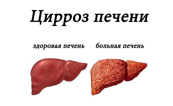 Витамин а передозировка симптомы