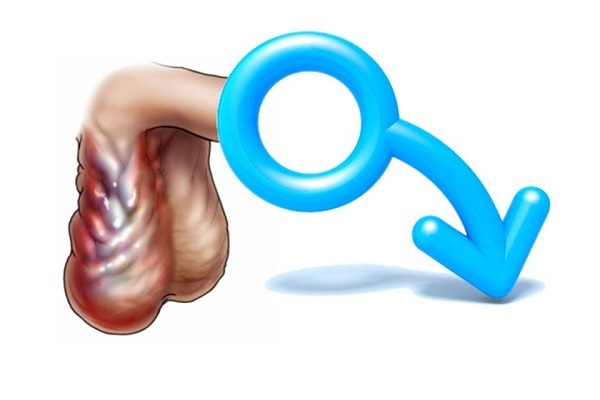 Влияет ли варикоцеле на потенцию: влияние на тестостерон, лечение импотенции, эффект от операции