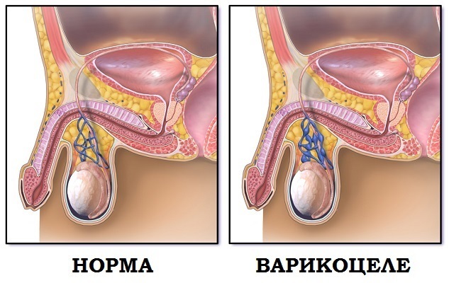 Влияет ли варикоцеле на потенцию: влияние на тестостерон, лечение импотенции, эффект от операции