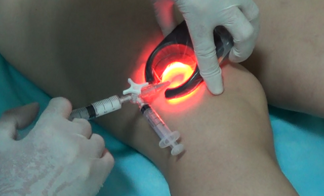 Внутренний варикоз на ногах (скрытый): симптомы и лечение