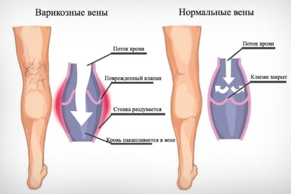 Внутренний варикоз на ногах (скрытый): симптомы и лечение