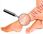 Внутренний варикоз на ногах (скрытый): симптомы и лечение