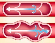 Внутренний варикоз на ногах (скрытый): симптомы и лечение