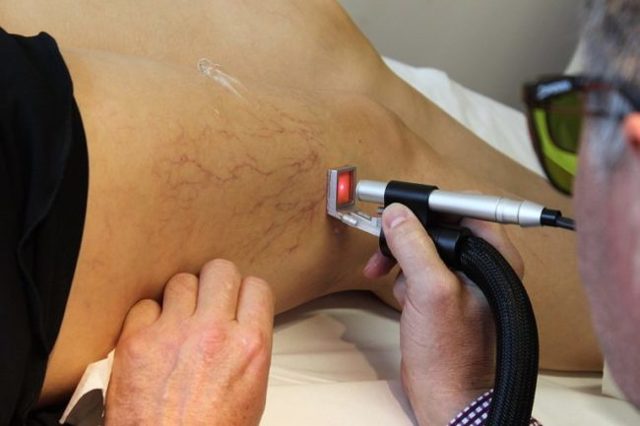 Внутренний варикоз на ногах (скрытый): симптомы и лечение