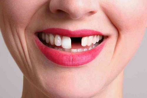 Выпали зубы во сне и что означают дырки по сонникам Ванги и Миллера