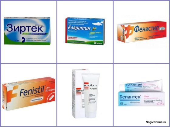 Зуд при варикозе: причины, лечение (медикаменты, народные средства, диетотерапия), возможные осложнения (трофические язвы, дерматит, экзема)