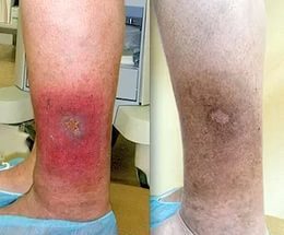 Зуд при варикозе: причины, лечение (медикаменты, народные средства, диетотерапия), возможные осложнения (трофические язвы, дерматит, экзема)